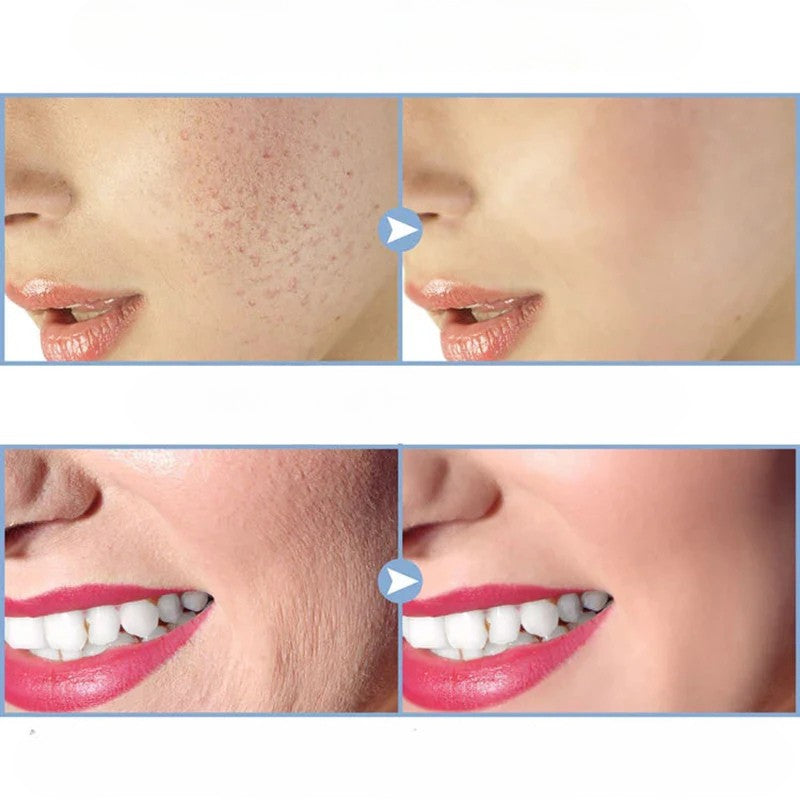 Appareil-de-massage-visage-et-cheveux-haute-frequence-traitement-de-acne-resultats